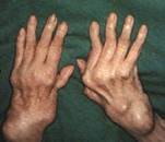 Revmatoidn artritida